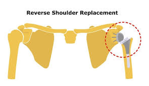 reverse shoulder replacement rehab