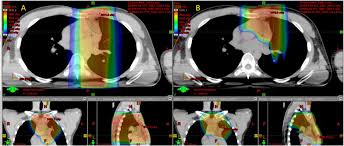 cases for proton beam radiotherapy