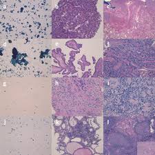 Fine needle aspiration cytology and histology did not correlate in 32 (20 per cent) patients and fnac was inadequate in nine (5.6 per cent) cases. A Core Needle Biopsy Provides More Malignancy Specific Results Than Fine Needle Aspiration Biopsy In Thyroid Nodules Suspicious For Malignancy Journal Of Clinical Pathology
