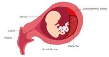Image result for icd 10 code for subchorionic bleed