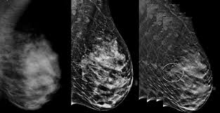 Digital Breast Tomosynthesis Uw Health Madison Wi