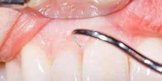 recurring swollen gums stop suffering
