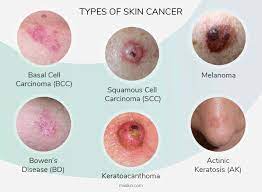 skin cancer pictures most common skin