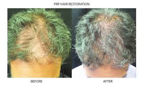 .a shedding phase or the microneedling can actually penetrate the skin deep enough to break the we do microneedling in our practice. Prp Microneedling And Hair Restoration New York City Manhattan Ny