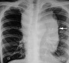 By the development of severe scarring (massive fibrosis or also known as conglomerate silicosis) where the small nodules become confluent, reach a size of 1 cm. Giant Malignant Mesothelioma In The Upper Mediastinum A Case Report