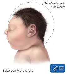 Image result for zika y microcefalia fotos