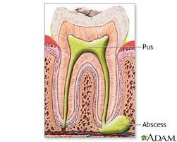 tooth extraction medlineplus cal