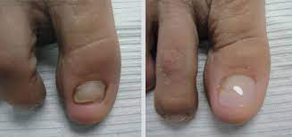 temporary nail replacement podiatry