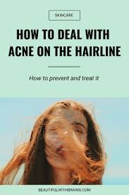 acne along the hairline