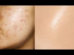 remove acne marks 3 step natural