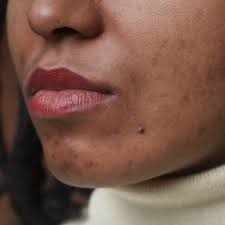 acne marks on dark skin