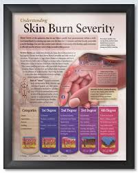 Understanding Skin Burn Severity Chart 20x26 Skin Burns