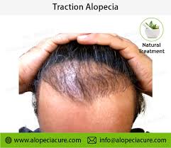 traction alopecia treatment