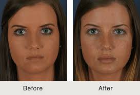lip injection procedures in charlotte nc