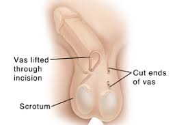 A vasectomy is a small operation a man has to prevent pregnancy. Having A Vasectomy Before During And After The Procedure Saint Luke S Health System