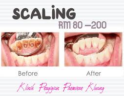 Hahaa rawatan scaling gigi klinik pergigian. Klinik Pergigian Premiere Kluang Posts Facebook
