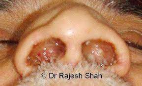 nasal polyps homeopathic treatment