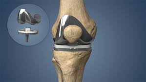 knee replacement surgery procedure