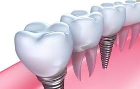 dental implants cost sydney 1500 99