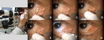 conjunctival cyst ablation using atmo