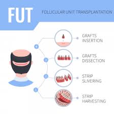 Hair Transplant In Iran Affordable Hair Transplant Cost