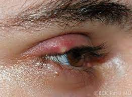 moran core what is a stye and how do