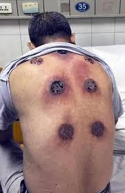 Cupping Points Chart Pdf Cupping Points Diagram New Hijama