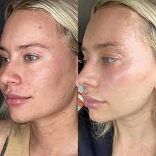 laser skin resurfacing types effects