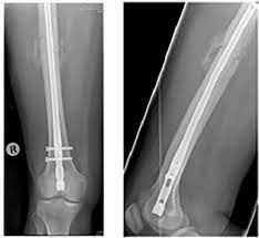 healing essment of fractured femur