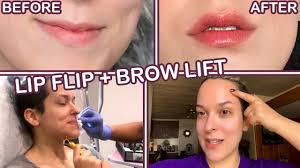 i got botox lip flip brow lift 11 s