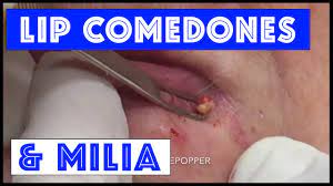 milia around the mouth that were