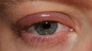 infected eye 8 common causes
