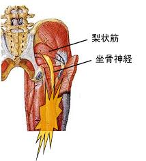 「梨状筋」の画像検索結果