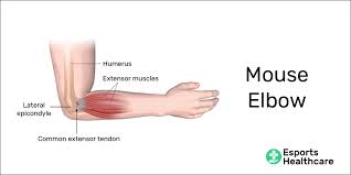 Actions.—these muscles act upon the forearm, the wrist, and hand. Mouse Elbow A Devastating Injury For Pc Gamers Esports Healthcare