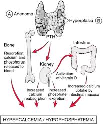 hyperparathyroidism stepwards