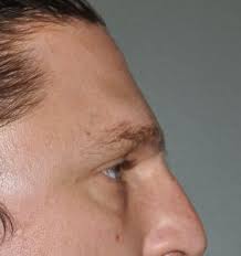 brow bone forehead reduction sugeon