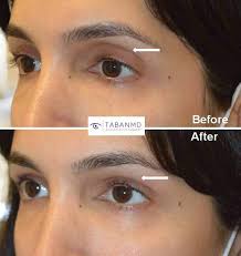 eyelid filler injection before and