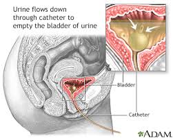 bladder biopsy information mount