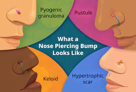 nose piercing p symptoms causes