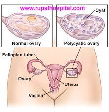 Endometriosis affects an estimated 176 million women worldwide regardless of their ethnic and social background. Pcos Treatment In Surat Rupal Hospital