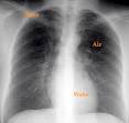 Fluid Around the Lungs or Malignant Pleural Effusion t