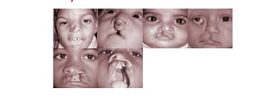 birth defects treatment services at