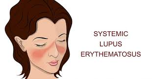 the lupus erfly rash