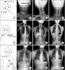 spinal deformity merement in terms