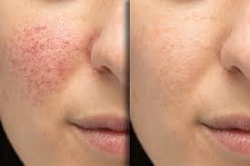 laser treatments dr dubow