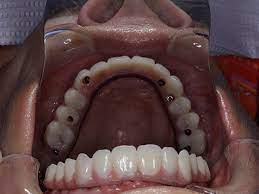 How Much Does It Cost For Full Dental Implants In Mexico gambar png