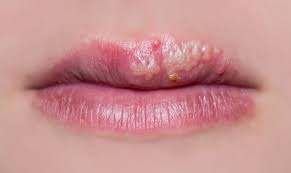 pictures of herpes sores