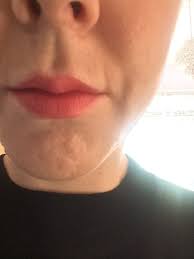 mouth after juvederm photo