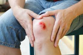 Image result for picture of child with scraped knee