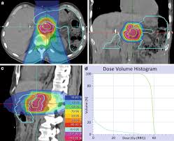 carbon ion radiotherapy as definitive